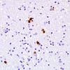 1C3 Globular Glial Tauopathy (Case 1) L19 PHF1 3.jpg