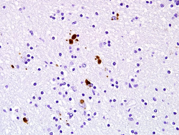 1C3 Globular Glial Tauopathy (Case 1) L19 PHF1 3.jpg