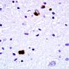 1C4 Globular Glial Tauopathy (Case 1) L19 PHF1 8.jpg