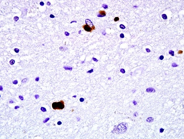 1C4 Globular Glial Tauopathy (Case 1) L19 PHF1 8.jpg