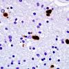 1C5 Globular Glial Tauopathy (Case 1) L19 PHF1 6.jpg