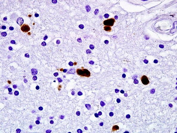 1C5 Globular Glial Tauopathy (Case 1) L19 PHF1 6.jpg