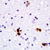 1C6 Globular Glial Tauopathy (Case 1) L19 PHF1 7.jpg