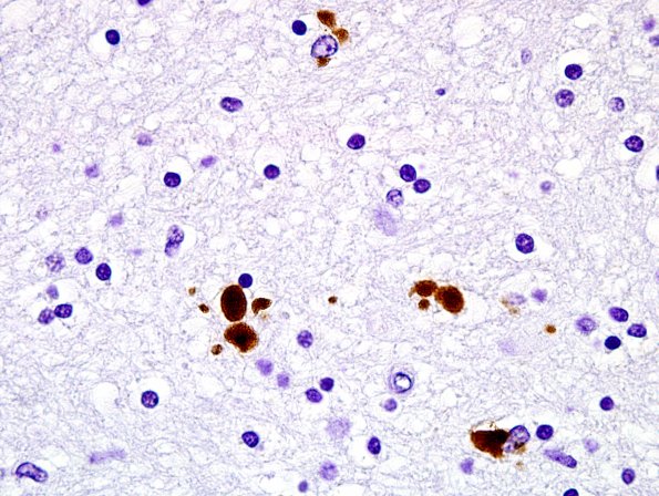 1C6 Globular Glial Tauopathy (Case 1) L19 PHF1 7.jpg