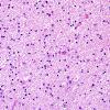 1D1 Globular Glial Tauopathy (Case 1) L23 Entorhinal WM H&E 4.jpg