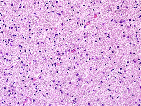 1D1 Globular Glial Tauopathy (Case 1) L23 Entorhinal WM H&E 4.jpg