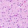 1D2 Globular Glial Tauopathy (Case 1) L23 Entorhinal WM H&E 3.jpg