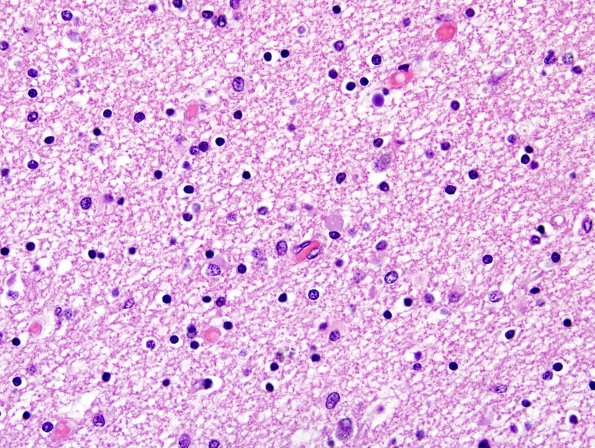 1D2 Globular Glial Tauopathy (Case 1) L23 Entorhinal WM H&E 3.jpg