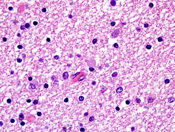 1D3 Globular Glial Tauopathy (Case 1) L23 Entorhinal WM H&E 11.jpg