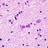 1D4 Globular Glial Tauopathy (Case 1) L23 Entorhinal WM H&E 7.jpg