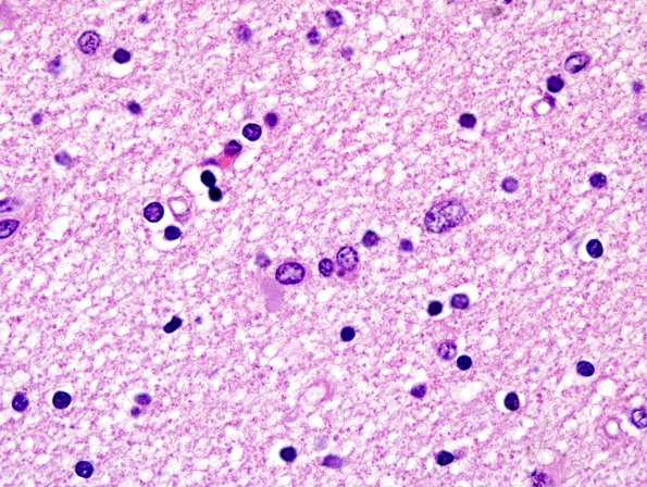 1D4 Globular Glial Tauopathy (Case 1) L23 Entorhinal WM H&E 7.jpg