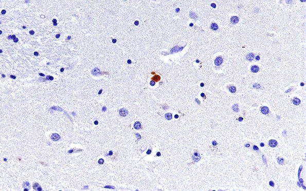 1G2 GGT (Case 1) L17 H&E 60X 2