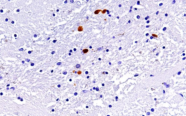 1G3 GGT (Case 1) L17 H&E 60X 3