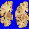 1A1  Hippocampal Sclerosis no AD (Case 1) Gross _1