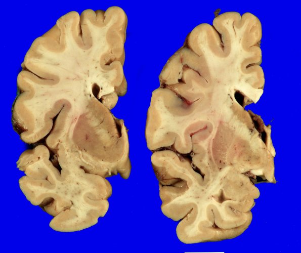 1A1  Hippocampal Sclerosis no AD (Case 1) Gross _1