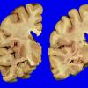 1A2 Hippocampal Sclerosis (Case 1) Gross _2