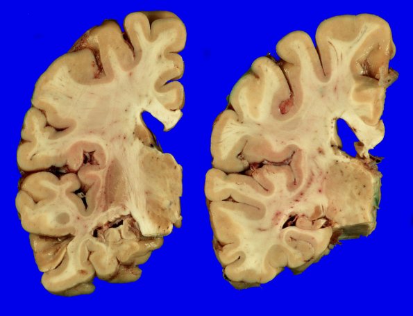 1A2 Hippocampal Sclerosis (Case 1) Gross _2