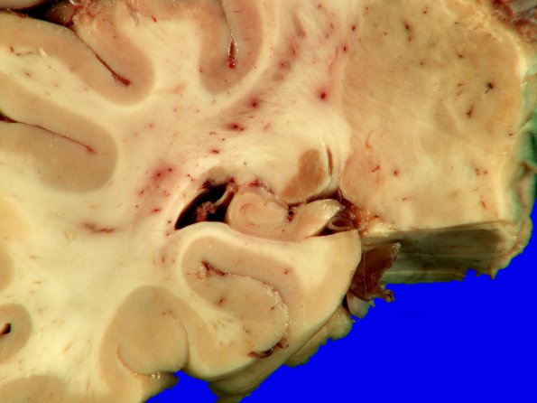 1A3 Hippocampal Sclerosis (Case 1) Gross _3