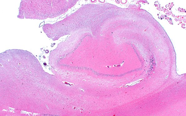 1B2 Hippocampal Sclerosis (Case 1) L5 H&E 2X