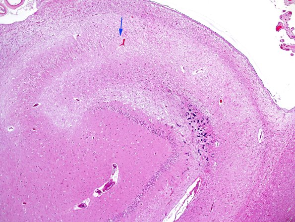 1B3 Hippocampal Sclerosis (Case 1) H&E 4X copy.jpg