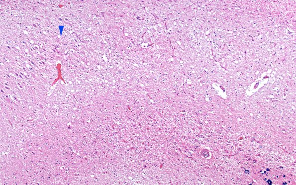 1B4 Hippocampal Sclerosis (Case 1) L5 H&E 10X copy