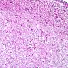 1B5 Hippocampal Sclerosis (Case 1) H&E 20X.jpg