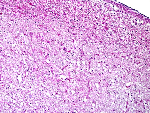 1B5 Hippocampal Sclerosis (Case 1) H&E 20X.jpg