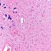 1B6 Hippocampal Sclerosis (Case 1) L5 H&E 20X