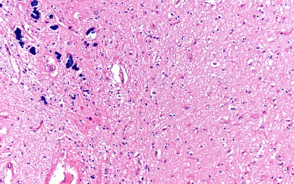 1B6 Hippocampal Sclerosis (Case 1) L5 H&E 20X