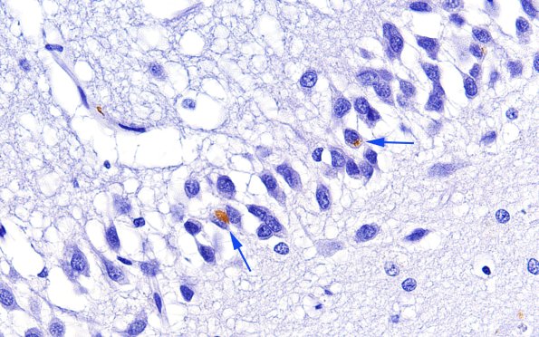 1C Hippocampal Sclerosis (Case 1) L5 TDP43 60X copy