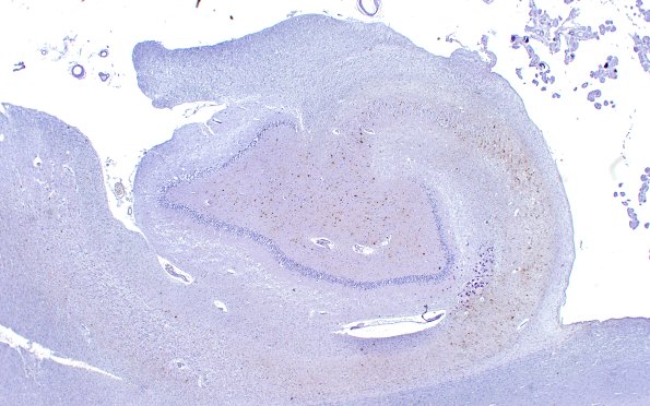 1D1 Hippocampal Sclerosis (Case 1) L5 PHF1 2X