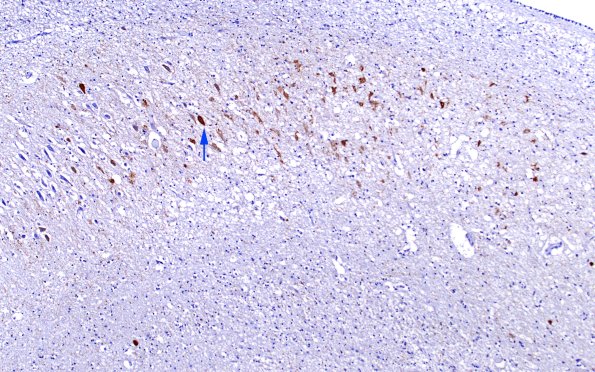 1D3 Hippocampal Sclerosis (Case 1) L5 PHF1 10X copy