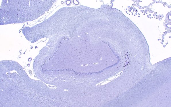 1E1 Hippocampal Sclerosis (Case 1) L5 BAP 2X