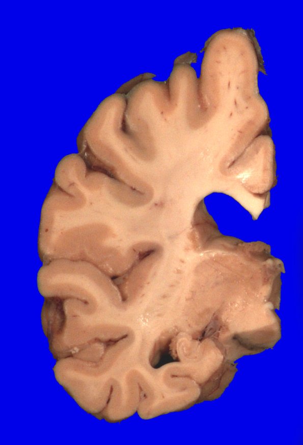 2A2 HS (Case 2) Gross_2