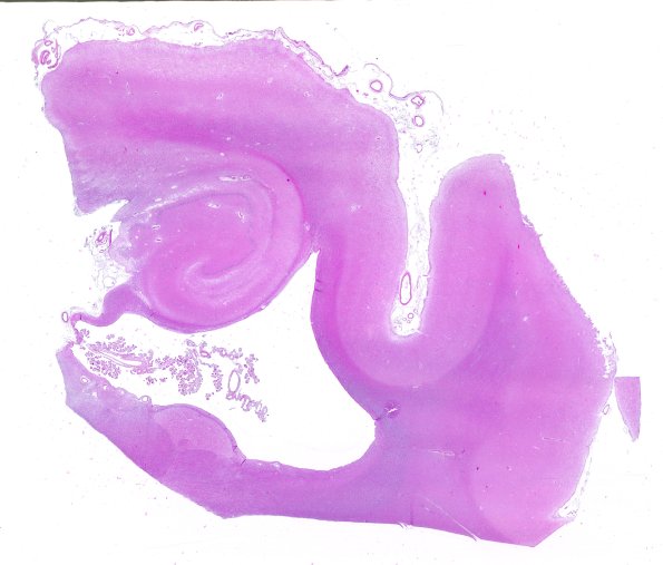 2B1 Hippocampal Sclerosis (Case 2) L5 H&E WM