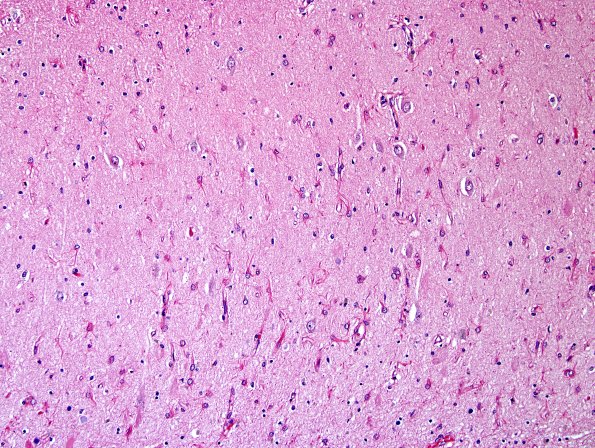 2B4 Hippocampal Sclerosis (Case 2) L5 H&E 20X 2.jpg