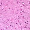 2B5 Hippocampal Sclerosis (Case 2) L5 H&E 4X 2.jpg