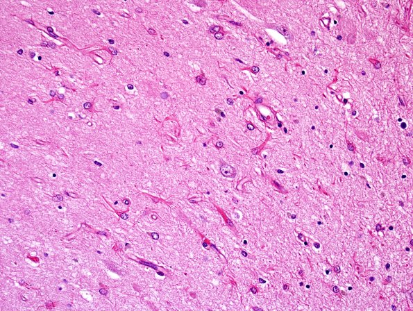 2B5 Hippocampal Sclerosis (Case 2) L5 H&E 4X 2.jpg