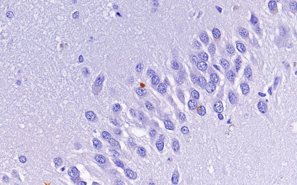 2C2 Hippocampal Sclerosis (Case 2) L5 TDP43 60X