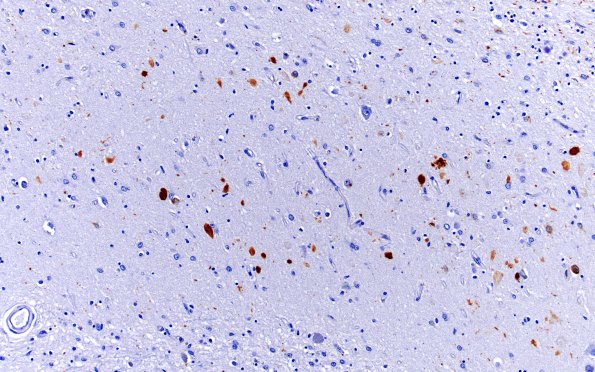 2D2 Hippocampal Sclerosis (Case 2) CA1 PHF