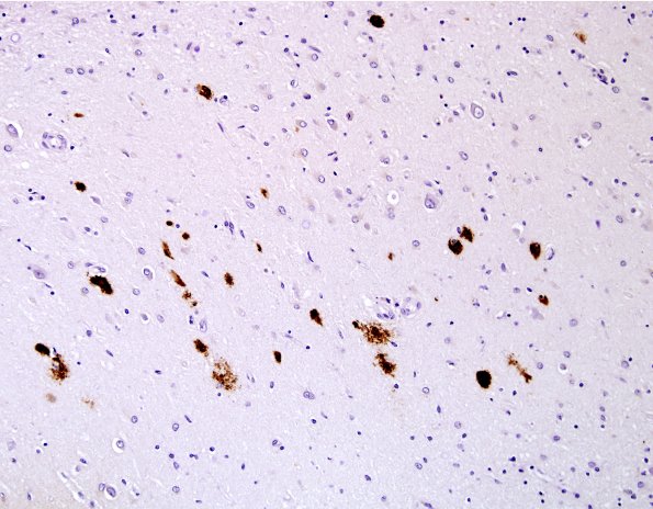 2E Hippocampal Sclerosis (Case 2) L5 Bamyloid 4X.jpg