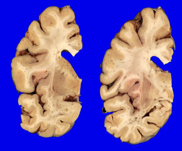 3A2 HScl (Case 3) Gross_1