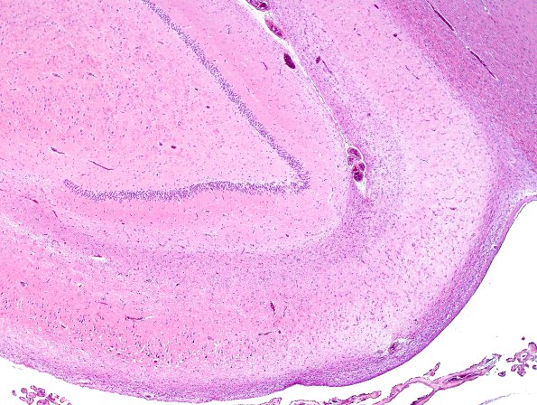 3B3 Hippocampal sclerosis (Case 3) H&E 2.jpg