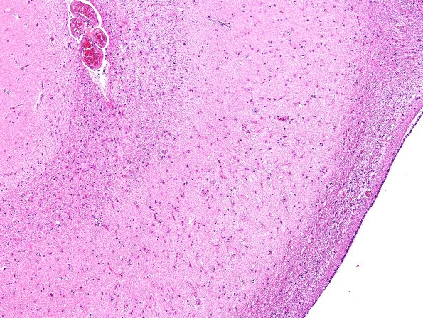 3B4 Hippocampal sclerosis (Case 3) H&E 1.jpg