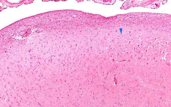 3B5 Hippocampal sclerosis (Case 3) H&E 10X copy