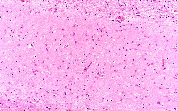 3B6 Hippocampal sclerosis (Case 3) H&E 20X subiculum