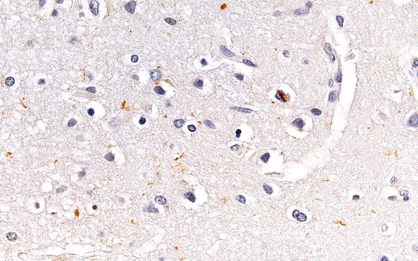 3C3 Hippocampal sclerosis (Case 3) TDP43 L1 TDP43 60X