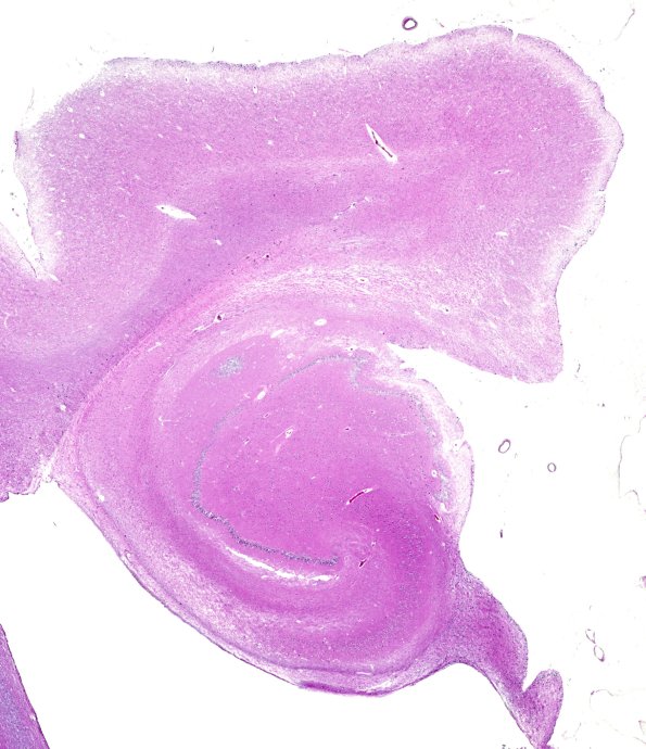 4A2 Argyrophilic Grain Dementia & Hippocampal sclerosis (Case 4) H&E whole mount 1