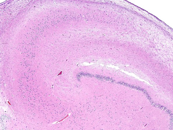 4A4 Argyrophilic Grain Dz & HC Sclerosis (Case 4) L5 H&E 1.jpg