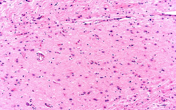 4A6 AGD & HS (Case 4) TDP43 L5 20X subiculum